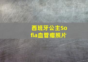 西班牙公主Sofia血管瘤照片